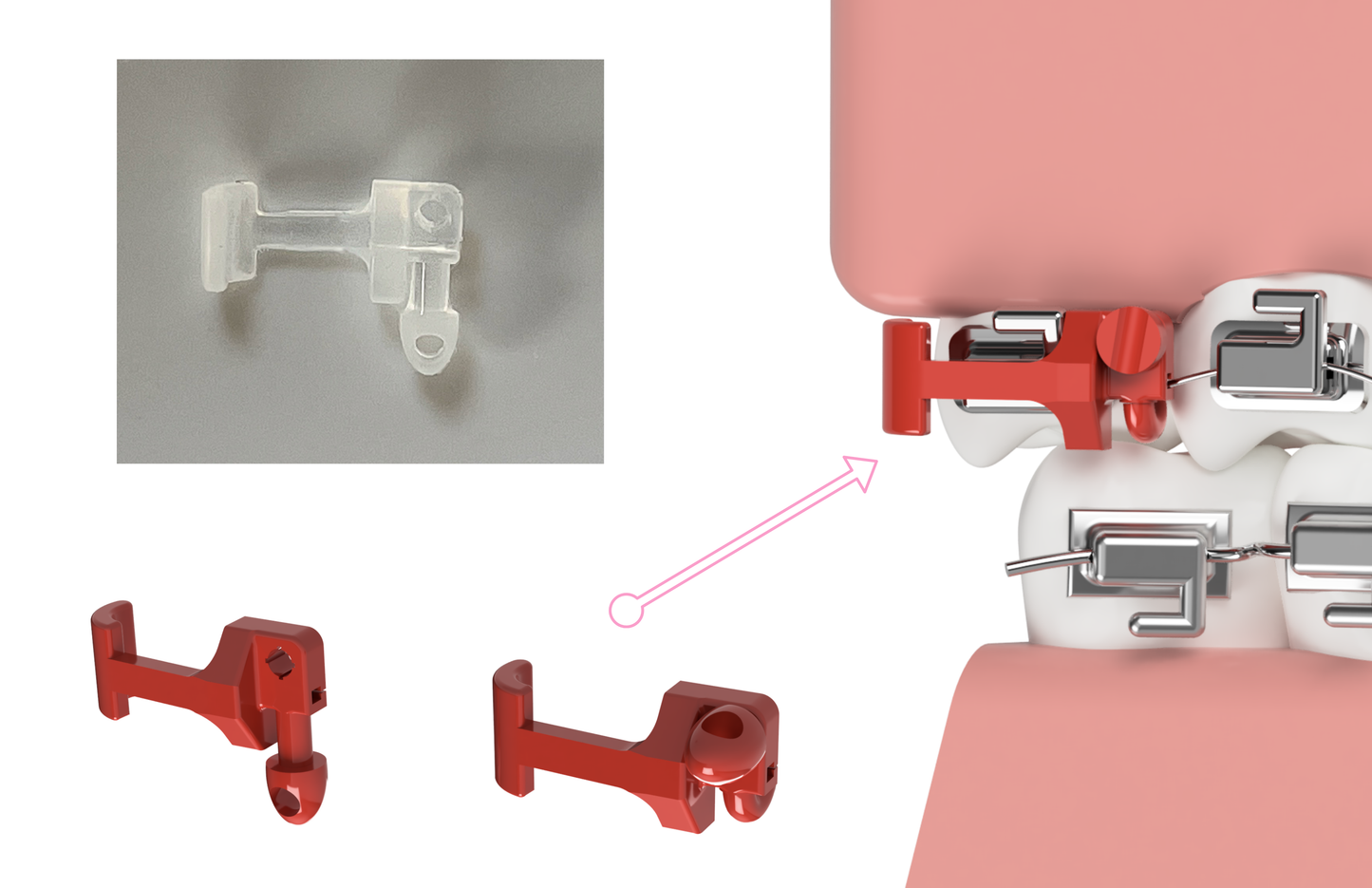 Brace Bumper - Two pack