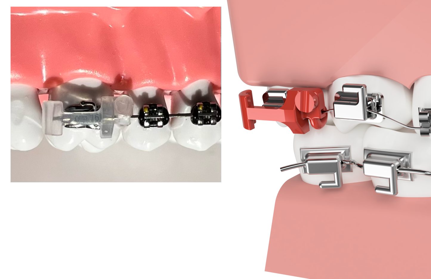 Brace Bumper - Two pack
