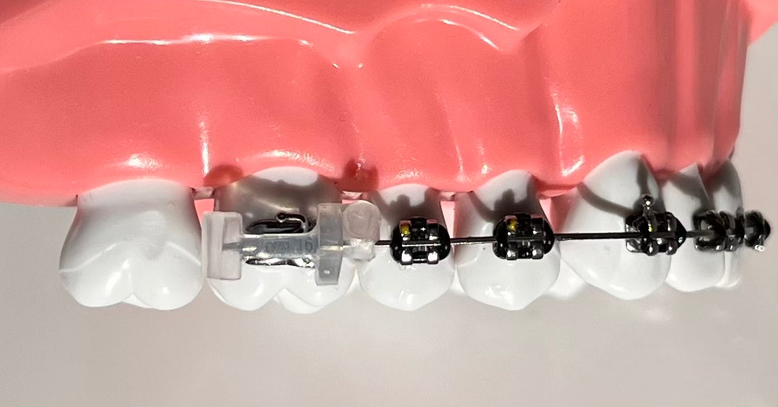 Brace Bumper - Two pack